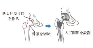 人工股関節置換術イラスト