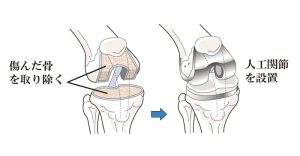 人工膝関節全置換術イラスト