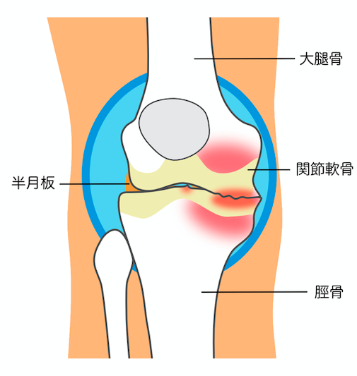 変形性膝関節症イラスト