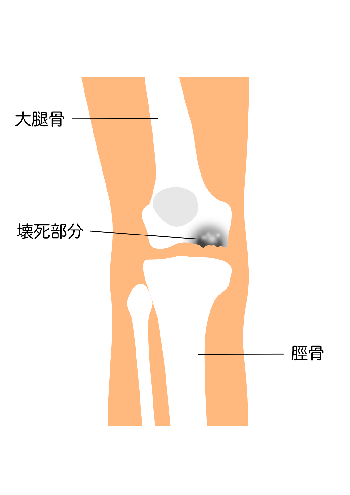 大腿骨内顆骨壊死イラスト